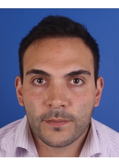 After Hair Transplant&nbsp;Front